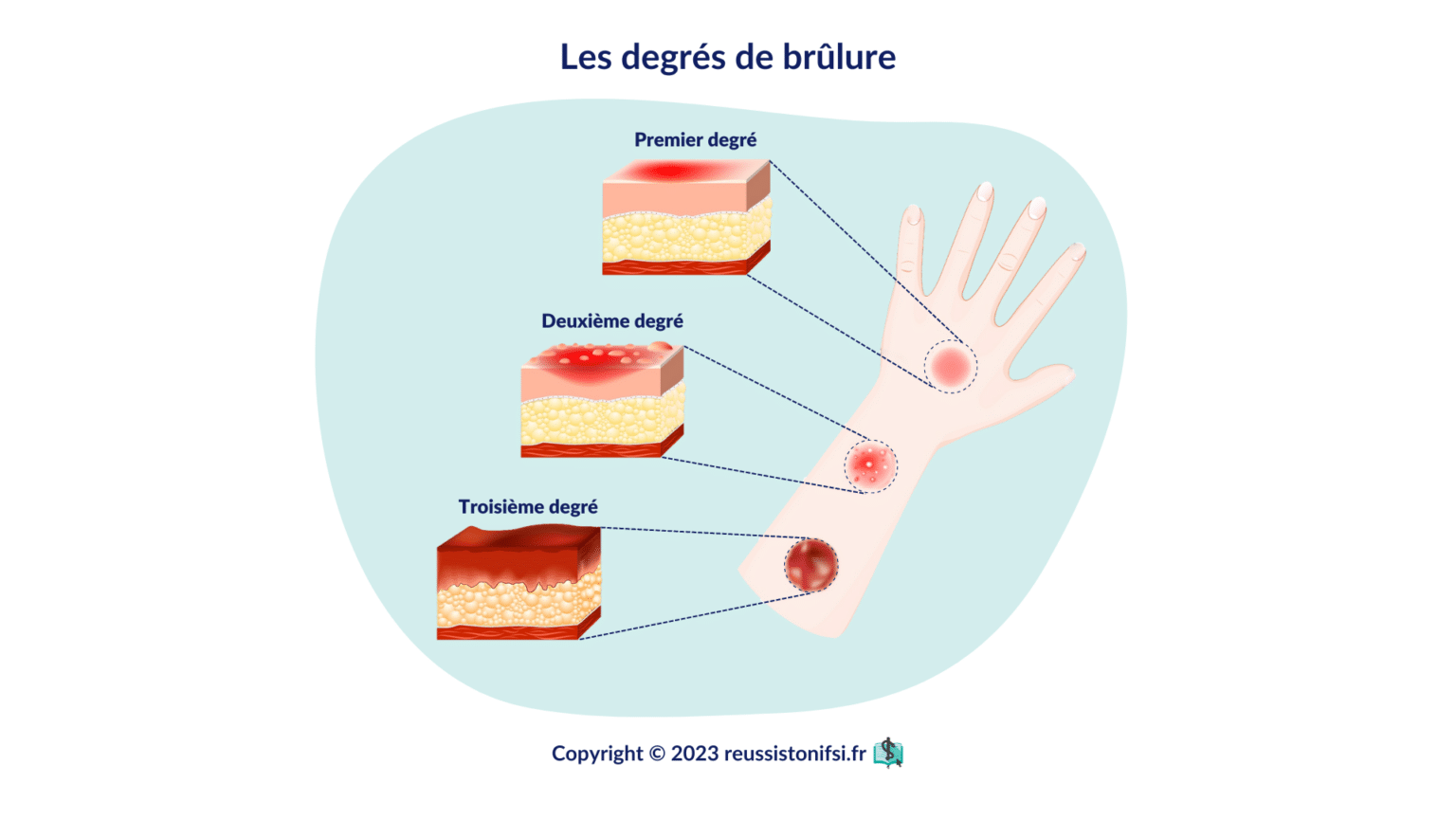 Guide Pratique Du Stage Infirmier En R Animation Des Grands Br L S