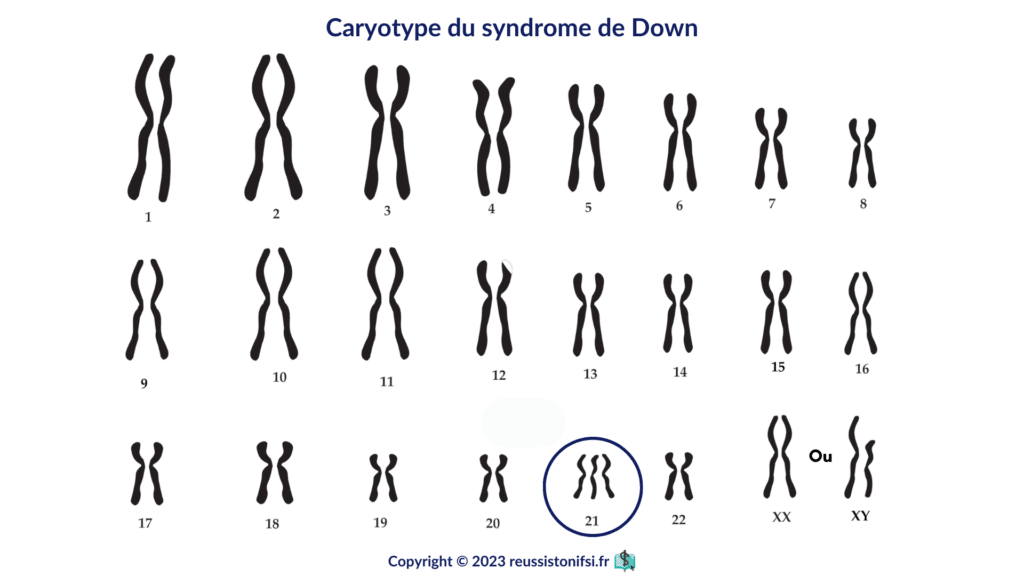 infographie - caryotype du syndrome de Down