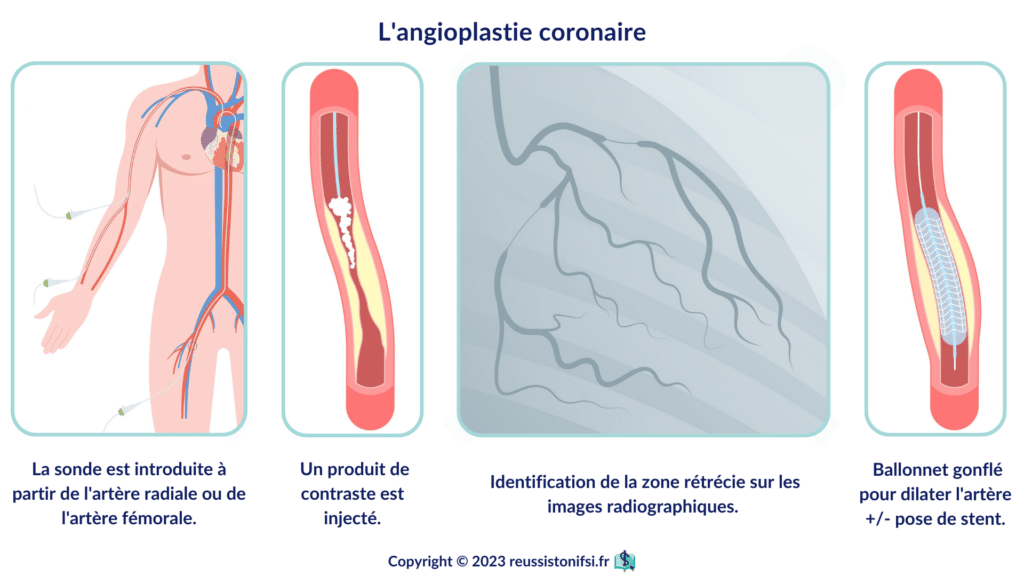 infographie - L'angioplastie coronaire