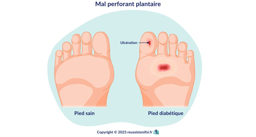 infographie - mal perforant plantaire