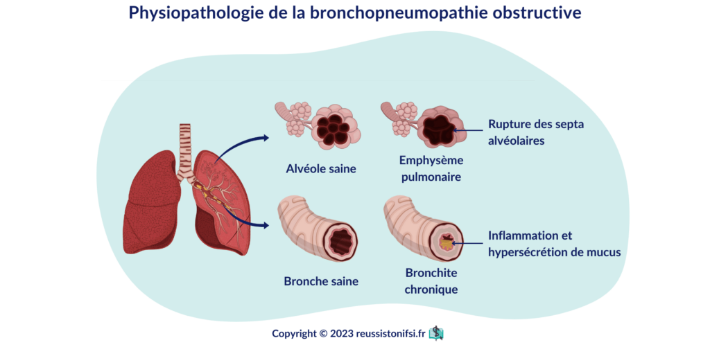 infographie - physiopathologie de la bronchopneumopathie obstructive