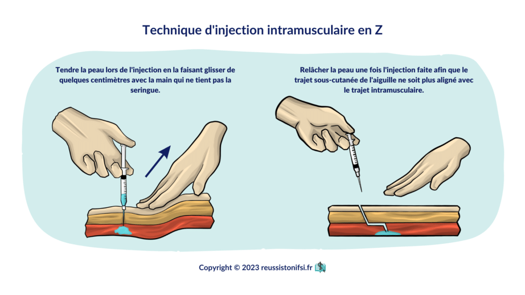 infographie - Technique d'injection intramusculaire en Z