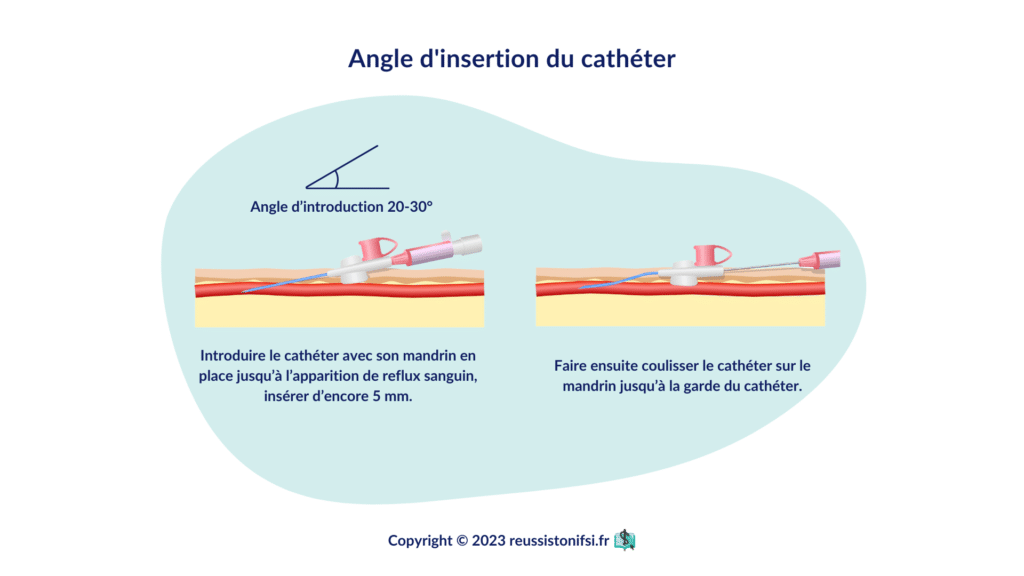 infographie - angle d'insertion du cathéter