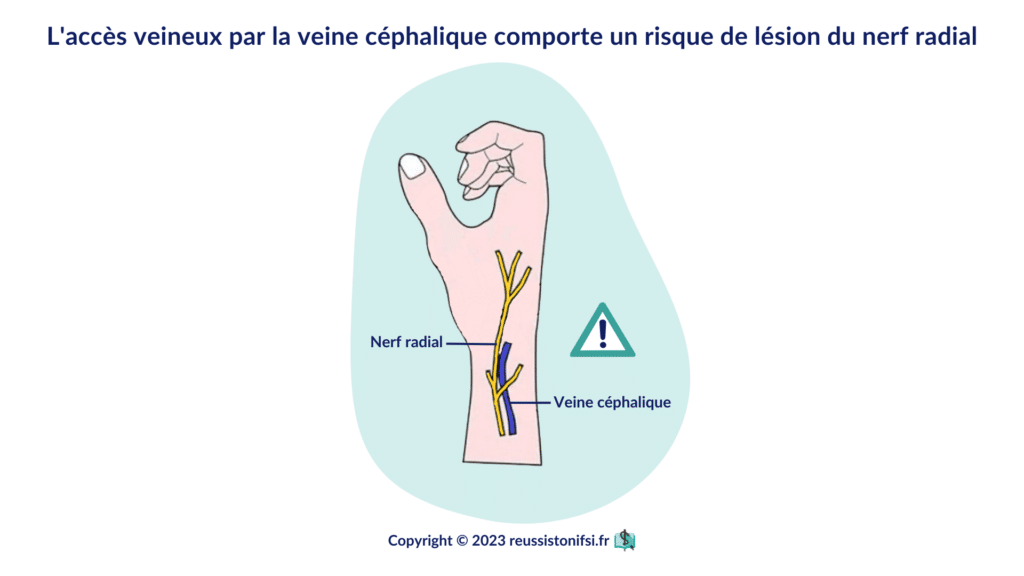 infographie - l'accès veineux par la veine céphalique comporte un risque de lésion du nerf radial