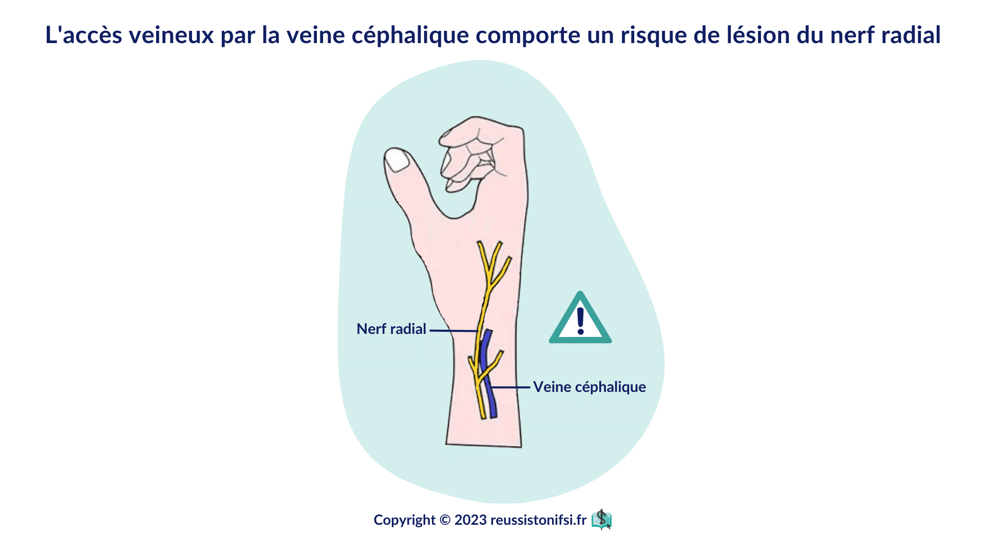 infographie - l'accès veineux par la veine céphalique comporte un risque de lésion du nerf radial