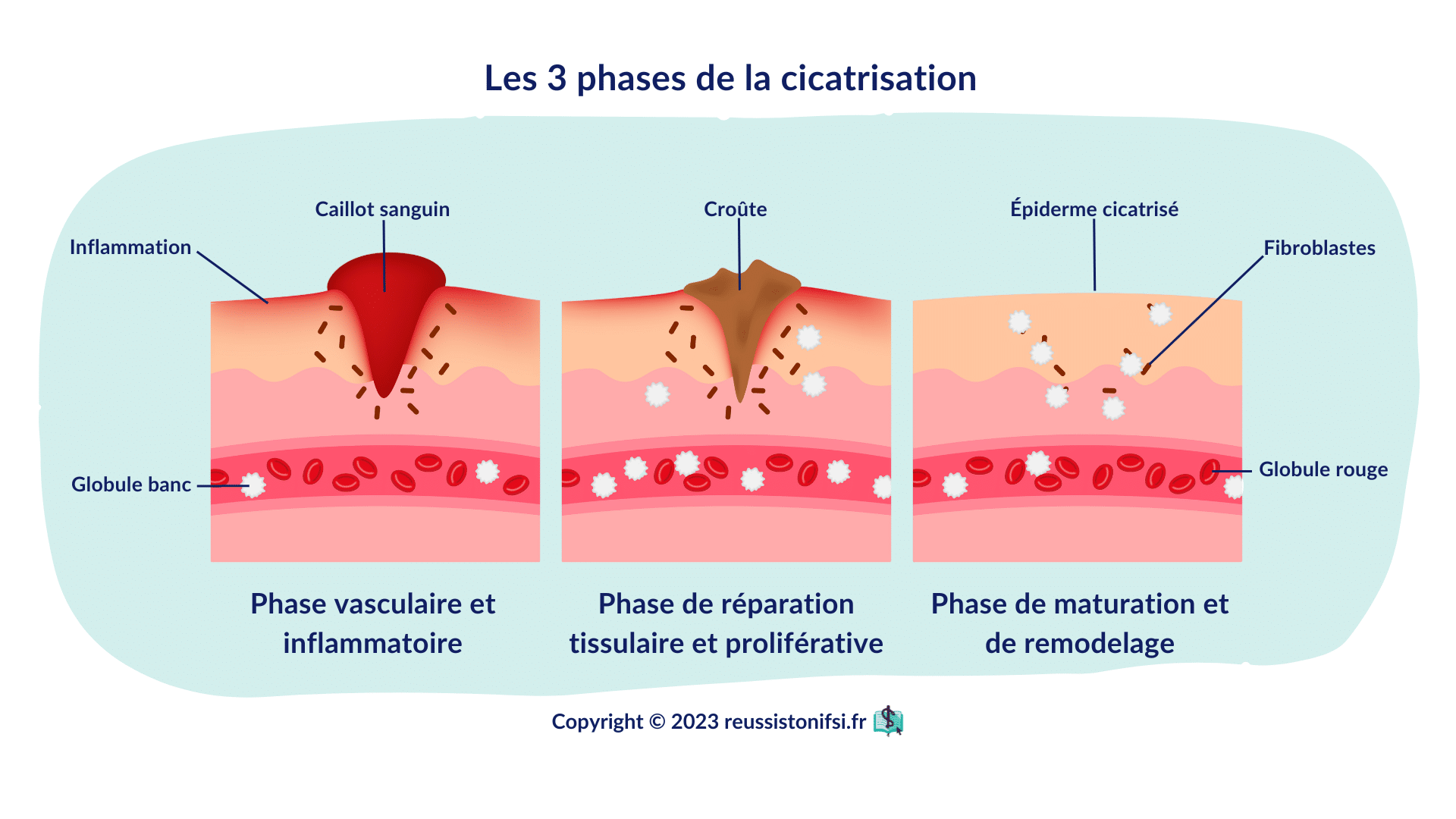 10 Conseils Pour La Cicatrisation Des Plaies Réussis Ton Ifsi 2403