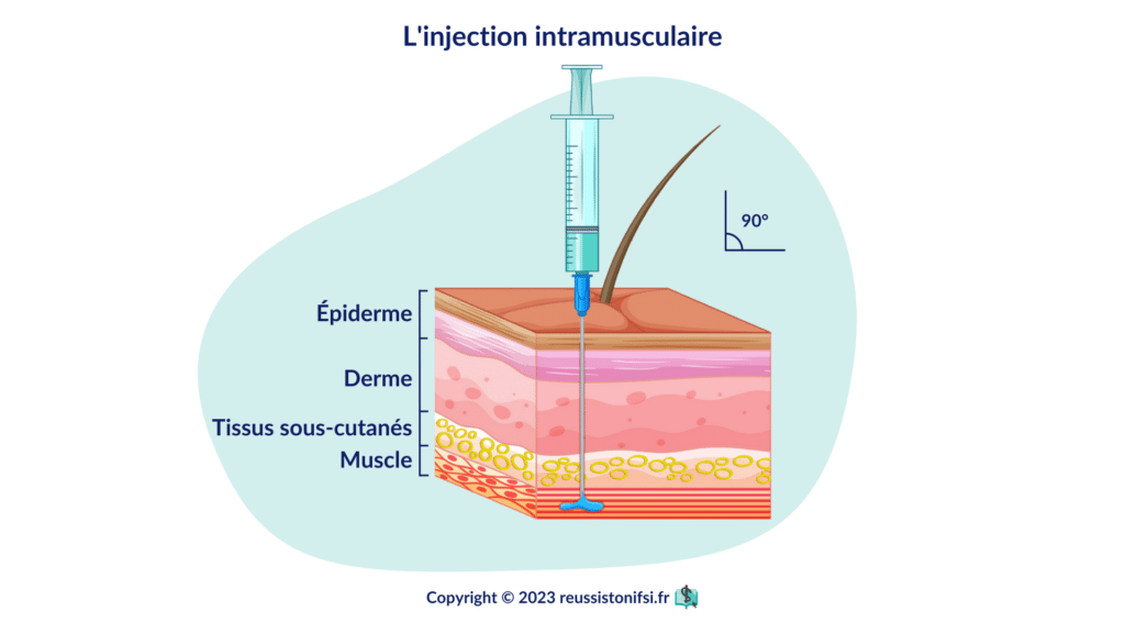 infographie - l'injection intramusculaire