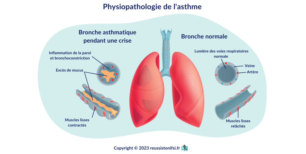 infographie - physiopathologie de l'asthme