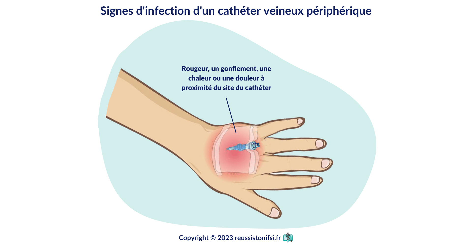 infographie -signes d'infection d'un cathéter veineux périphérique