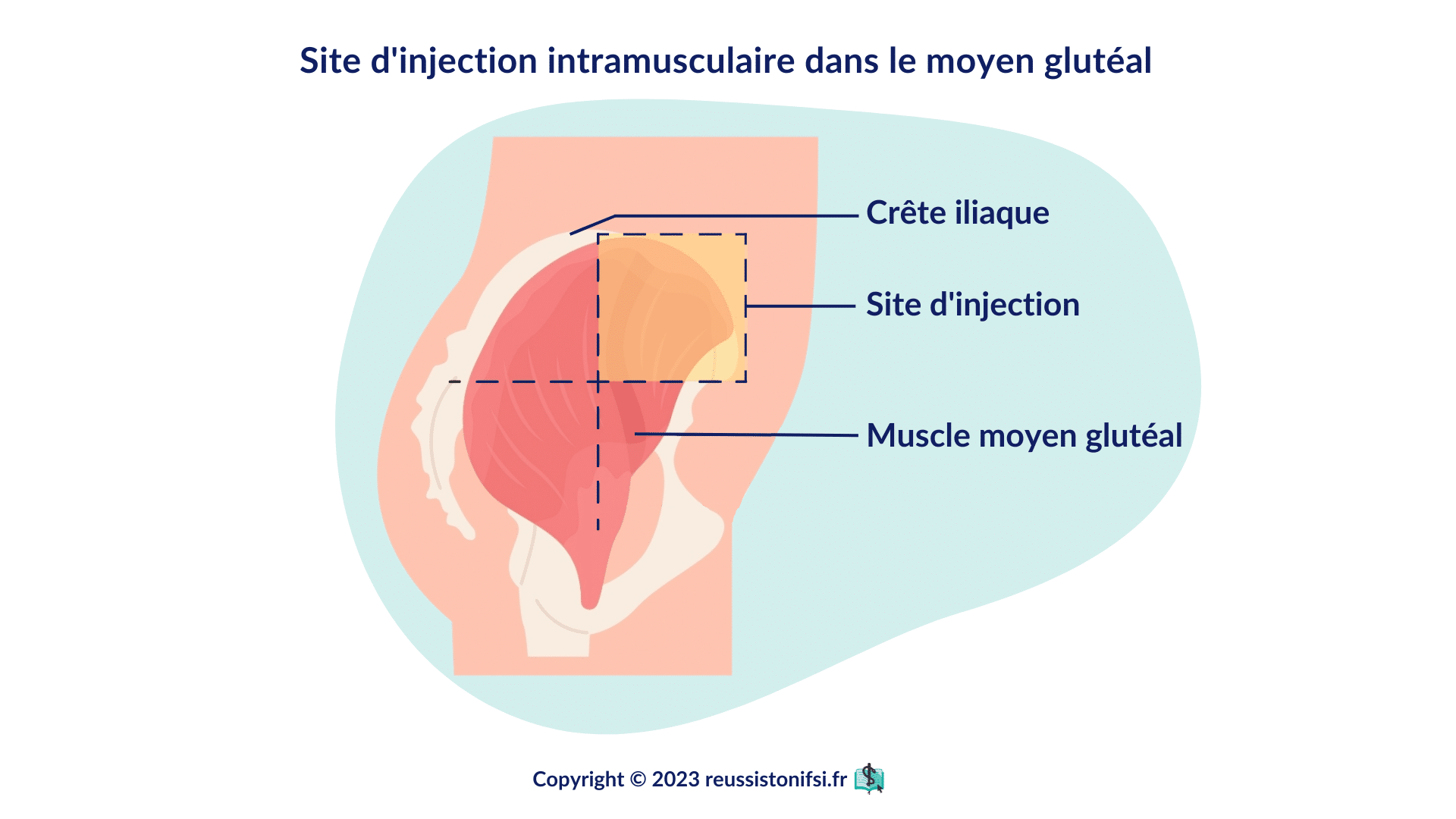 Injection intramusculaire dans le moyen glutéal avec repérage de la crête iliaque et du site d’injection sécurisé