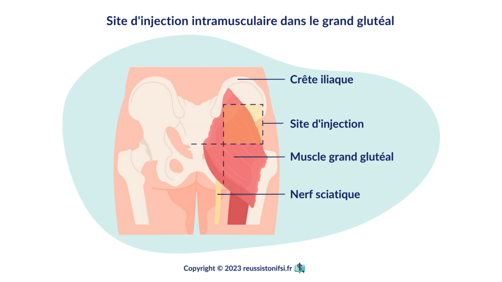 infographie - site d'injection intramusculaire dans le moyen glutéal