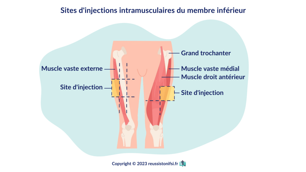 infographie - sites d'injections intramusculaires du membre inférieur