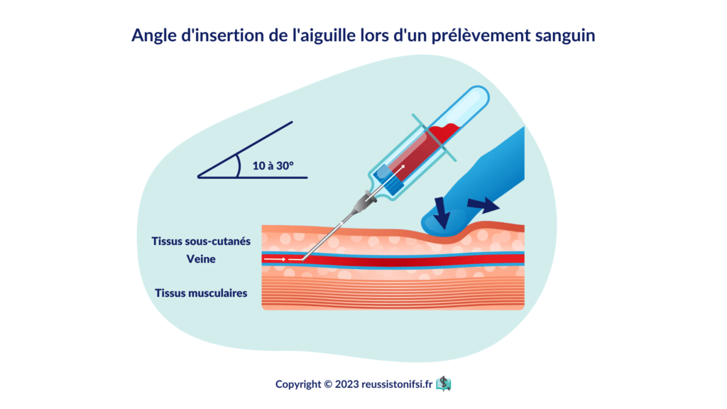 infographie - Angle d'insertion de l'aiguille lors d'un prélèvement sanguin