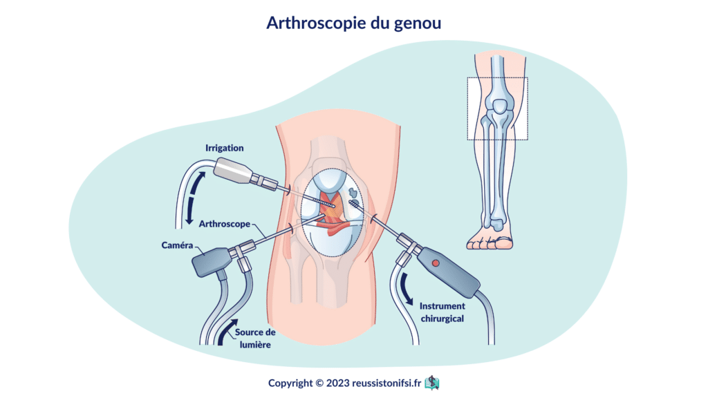 infographie - Arthroscopie du genou