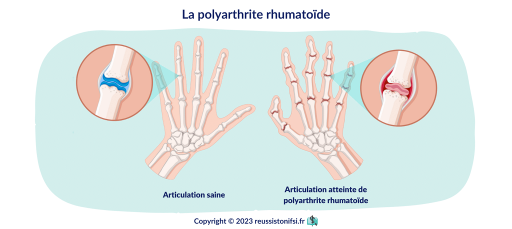 infographie - La polyarthrite rhumatoïde