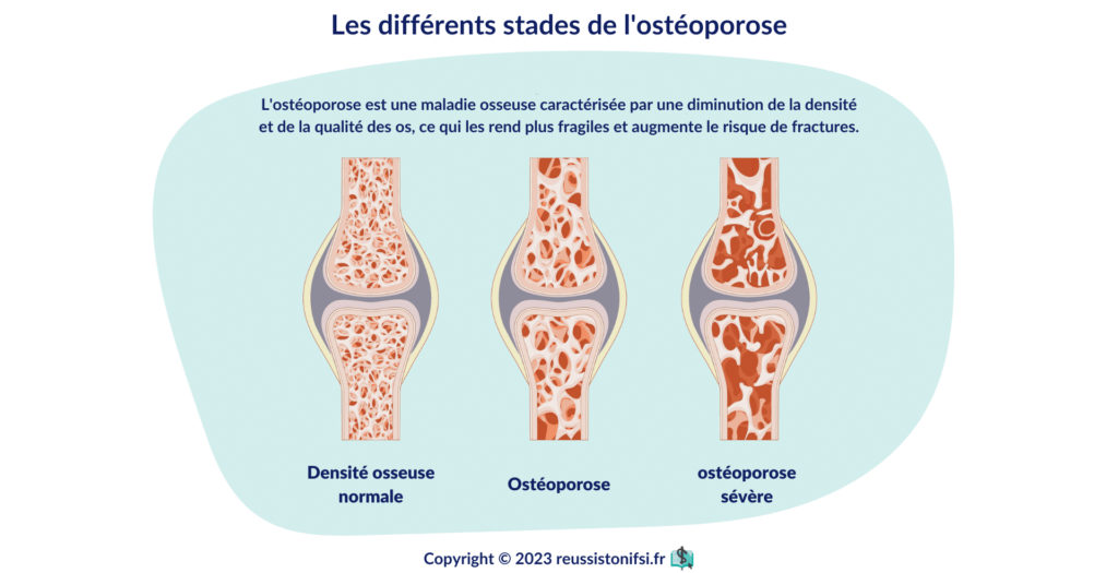 infographie - Les différents stades de l'ostéoporose