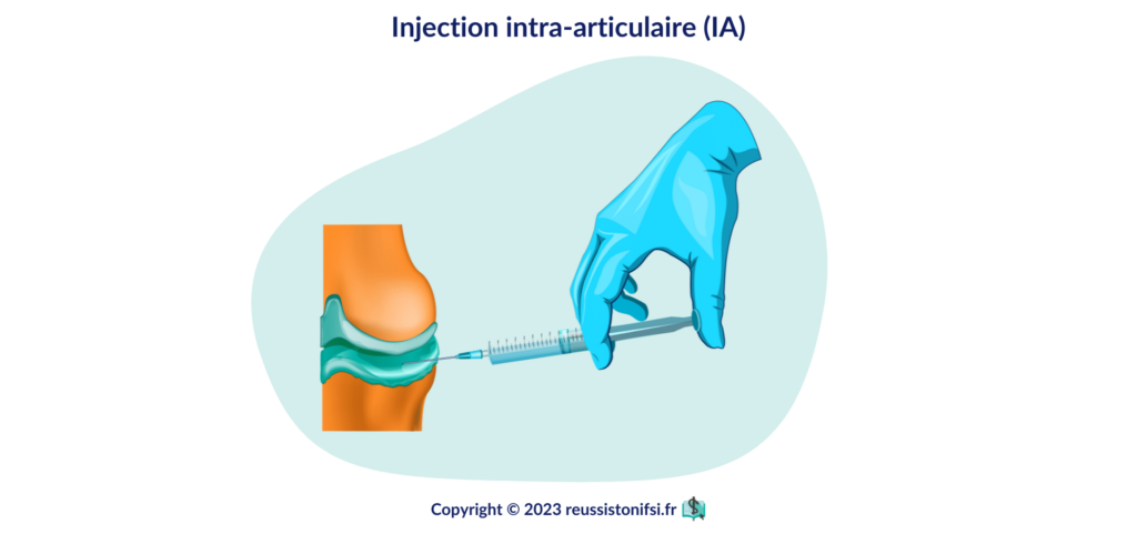 infographie - injection intra-articulaire