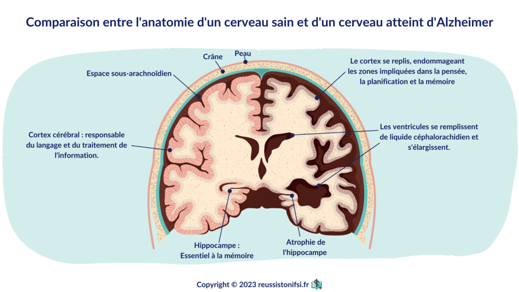 infographie - Comparaison entre l'anatomie d'un cerveau sain et d'un cerveau atteint d'Alzheimer