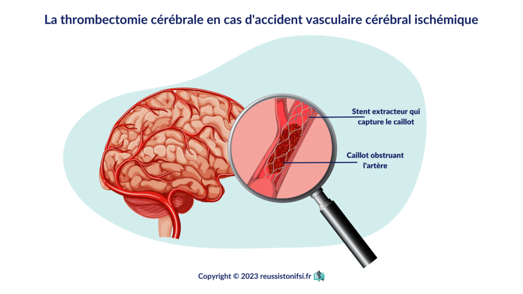 infographie - La thrombectomie cérébrale en cas d'accident vasculaire cérébral ischémique
