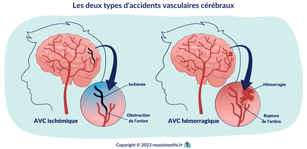 infographie - Les deux types d'accidents vasculaires cérébraux