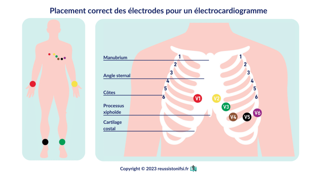 infographie - Placement correct des électrodes pour un électrocardiogramme
