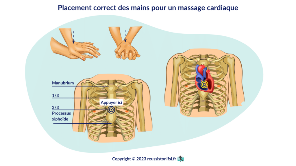 infographie - Placement correct des mains pour un massage cardiaque