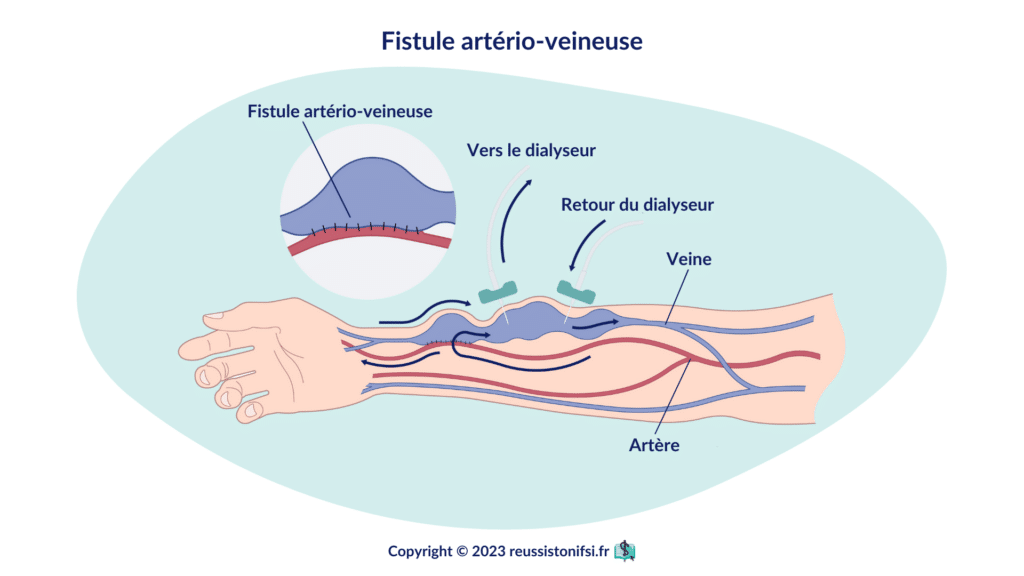 infographie - fistule artério-veineuse