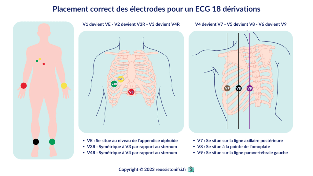 Infographie - ecg 18 dérivations