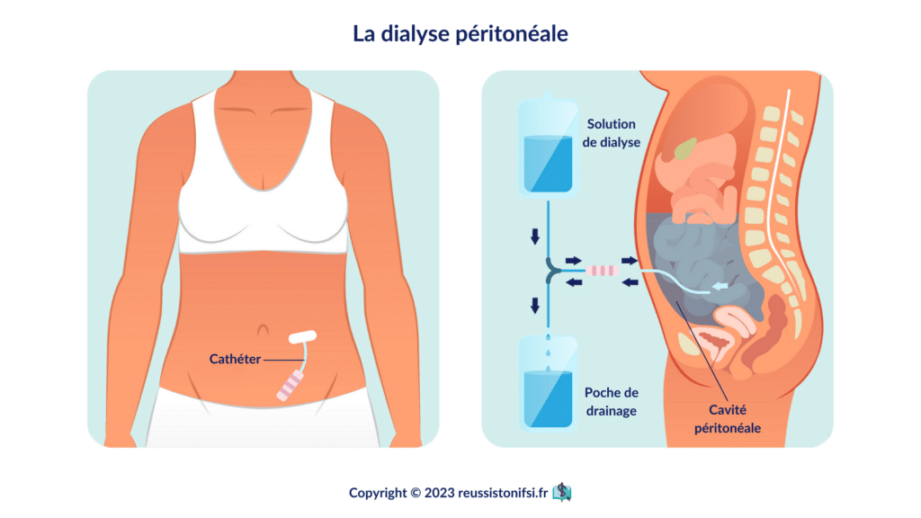 infographie - La dialyse péritonéale