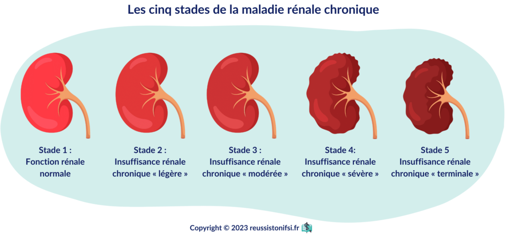 infographie - Les cinq stades de la maladie rénale chronique