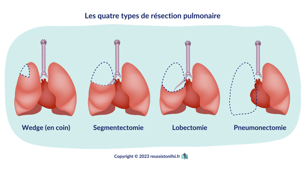 Infographie - Les quatre types de résection pulmonaire