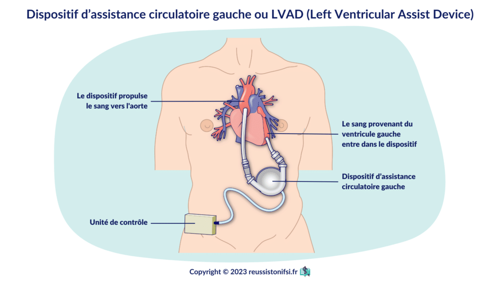 Infographie - Dispositif d’assistance circulatoire gauche ou LVAD (Left Ventricular Assist Device)