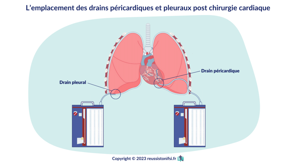 Infographie - L’emplacement des drains péricardiques et pleuraux post chirurgie cardiaque