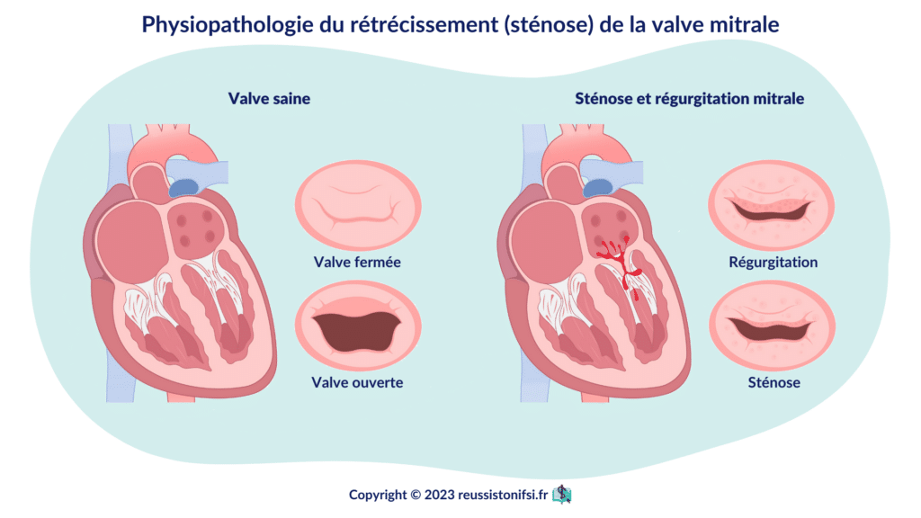 Infographie - Physiopathologie du rétrécissement (sténose) de la valve mitrale