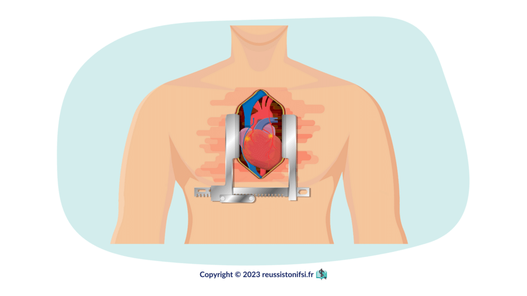 Infographie - Vignette d'article - Guide du stage infirmier en chirurgie cardiaque
