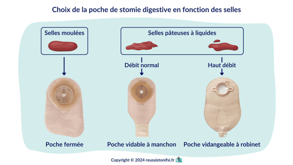 Infographie - Choix de la poche de stomie digestive en fonction des selles