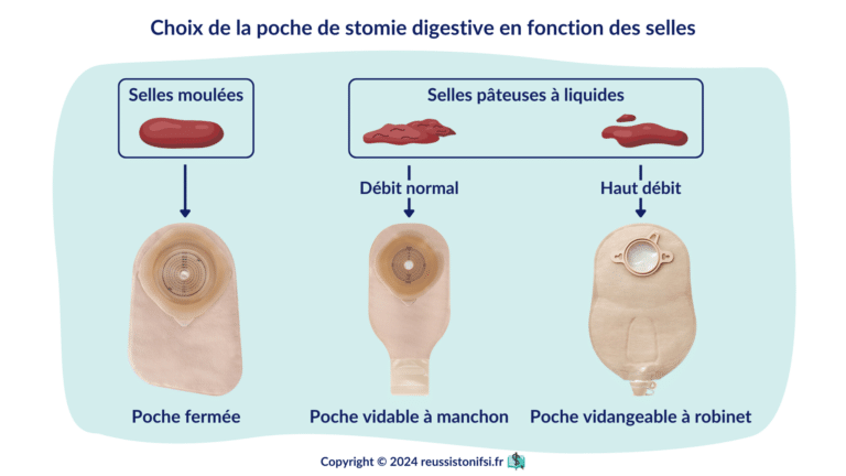 Guide infirmier : les soins de colostomie et d'iléostomie