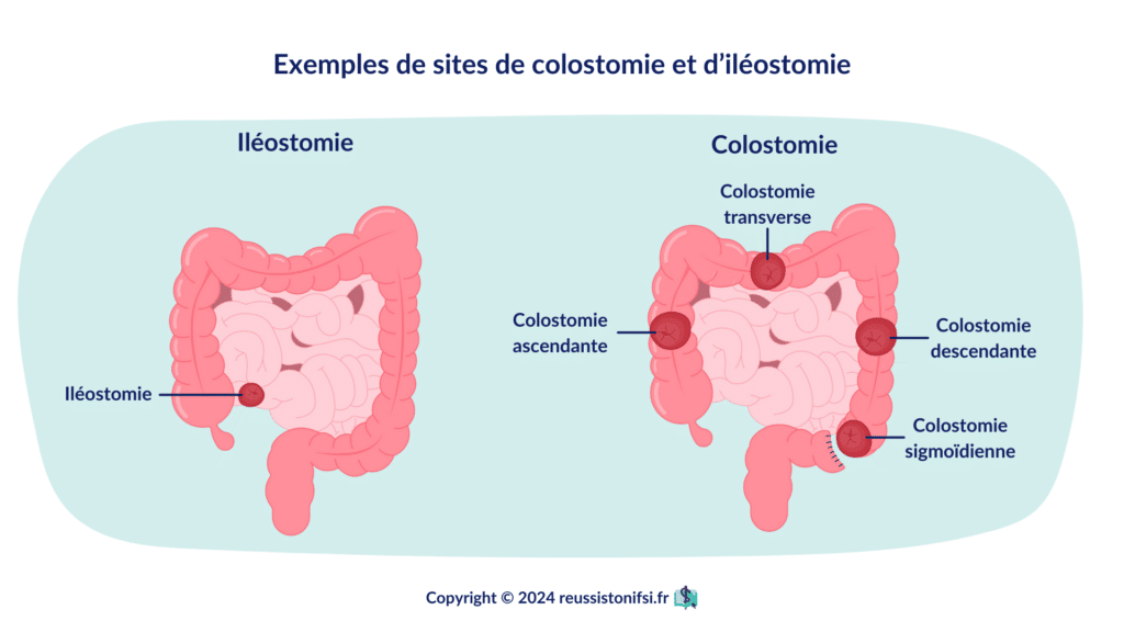 Infographie - Exemples de sites de colostomie et d’iléostomie