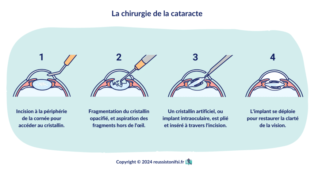 Infographie - La chirurgie de la cataracte