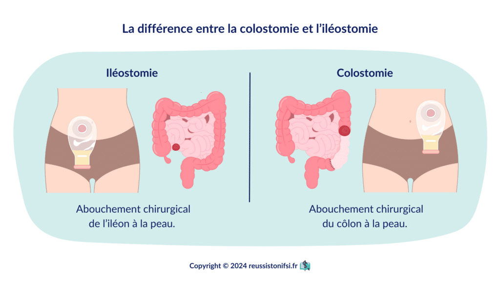 Infographie - La différence entre la colostomie et l’iléostomie