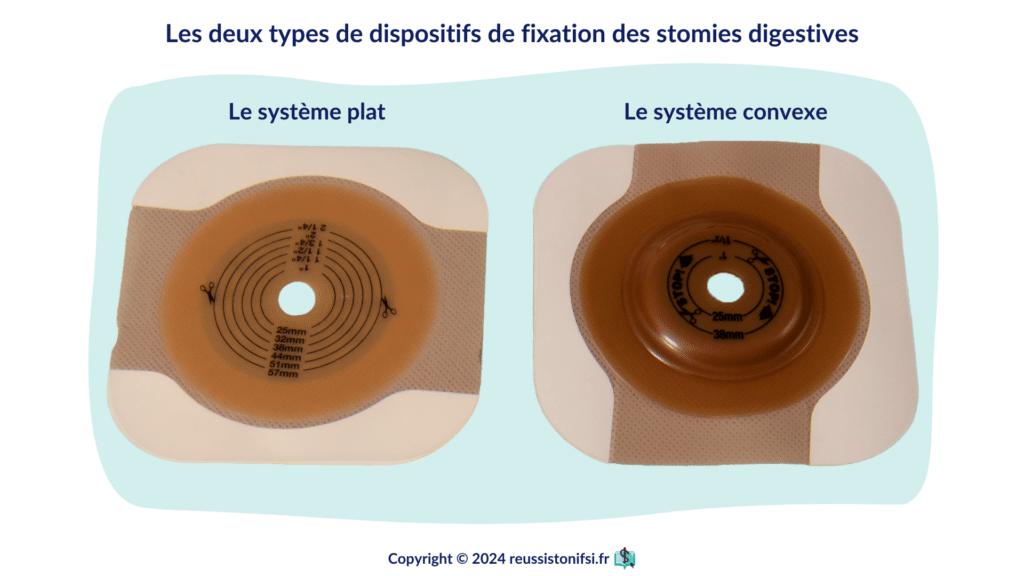 Infographie - Les deux types de dispositifs de fixation des stomies digestives