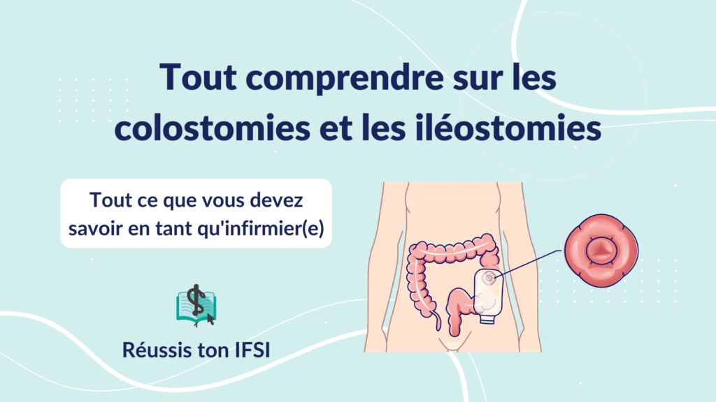 Vignette d'article -Tout comprendre sur les colostomies et les iléostomies