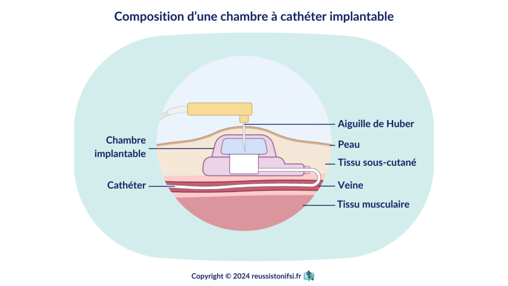 Infographie - Composition d’une chambre à cathéter implantable