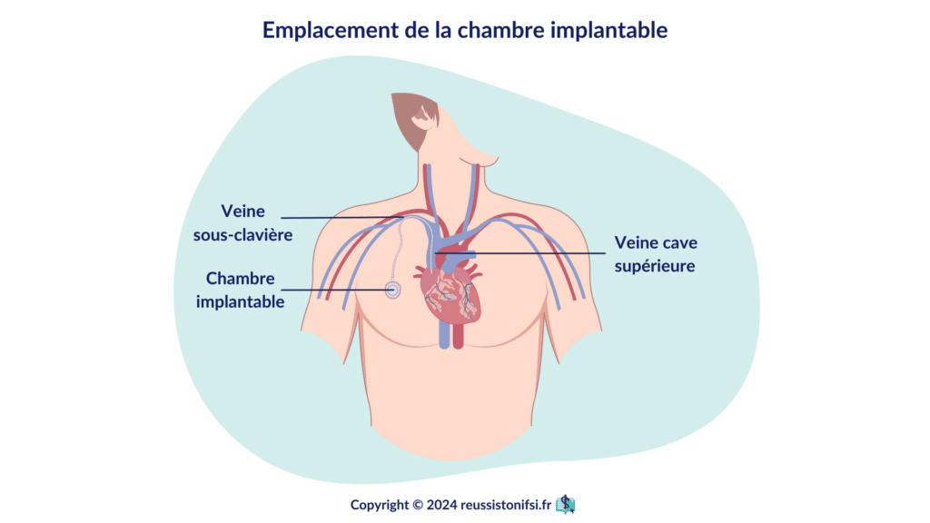 Infographie - Emplacement de la chambre implantable