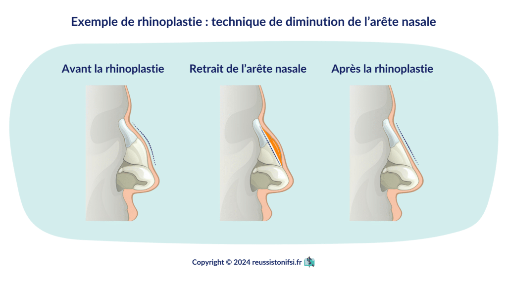 Infographie - Exemple de rhinoplastie _ technique de diminution de l’arête nasale