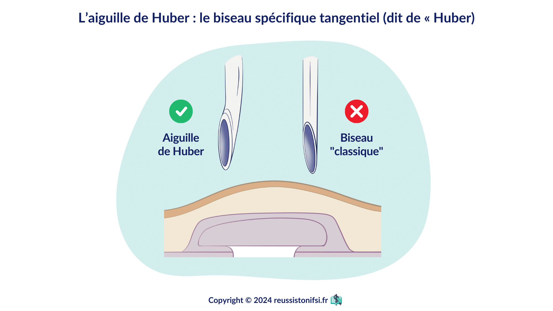 Infographie - L’aiguille de Huber _ le biseau spécifique tangentiel (dit de « Huber)