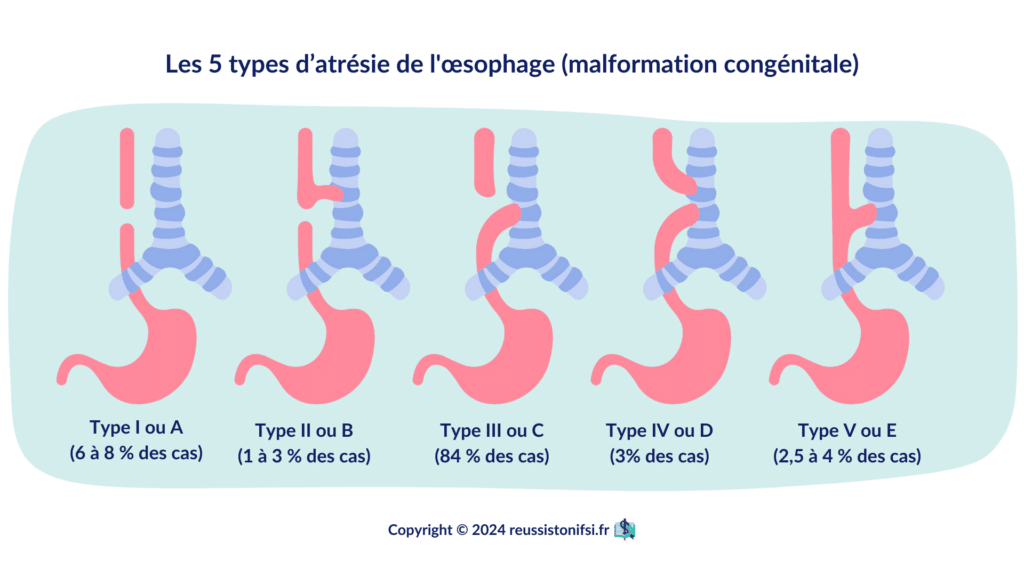 Infographie - Les 5 types d’atrésie de l'œsophage (malformation congénitale)