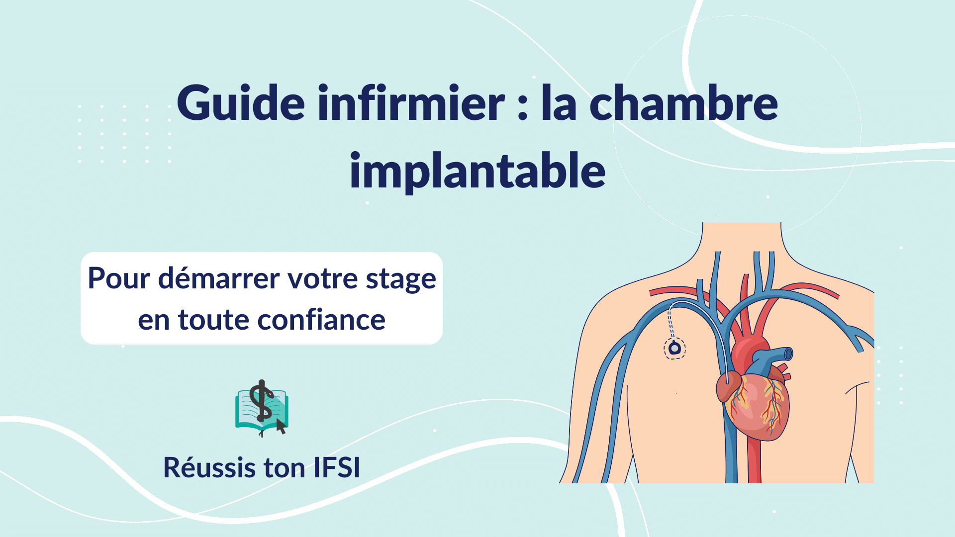 Vignette d'article - Guide infirmier _ la chambre implantable (CIP)