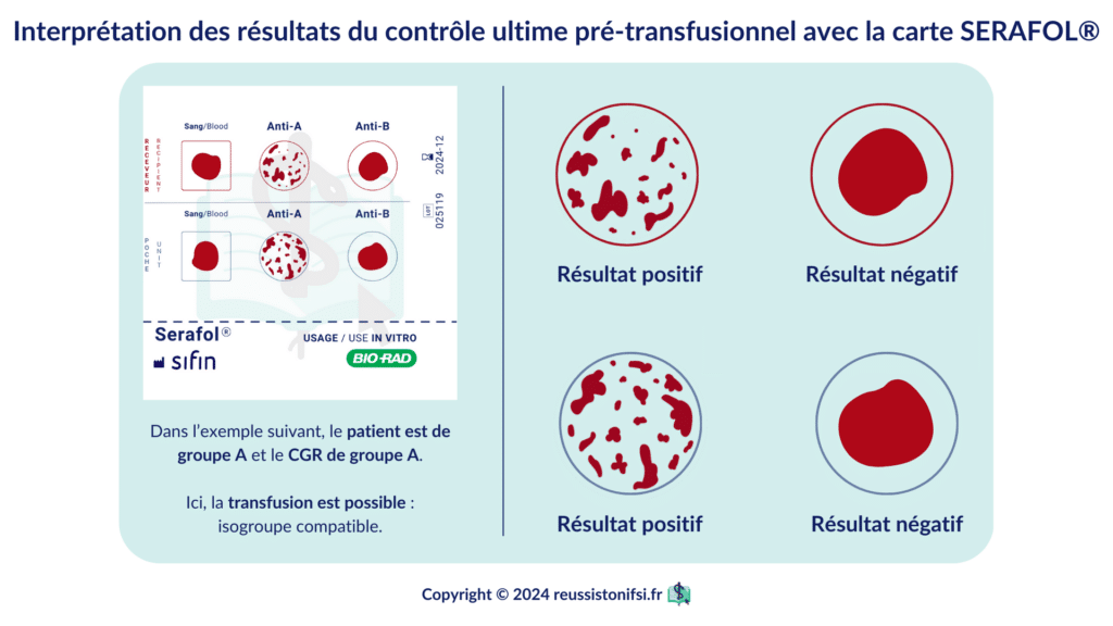 Infographie - Interprétation des résultats du contrôle ultime pré-transfusionnel avec la carte SERAFOL®