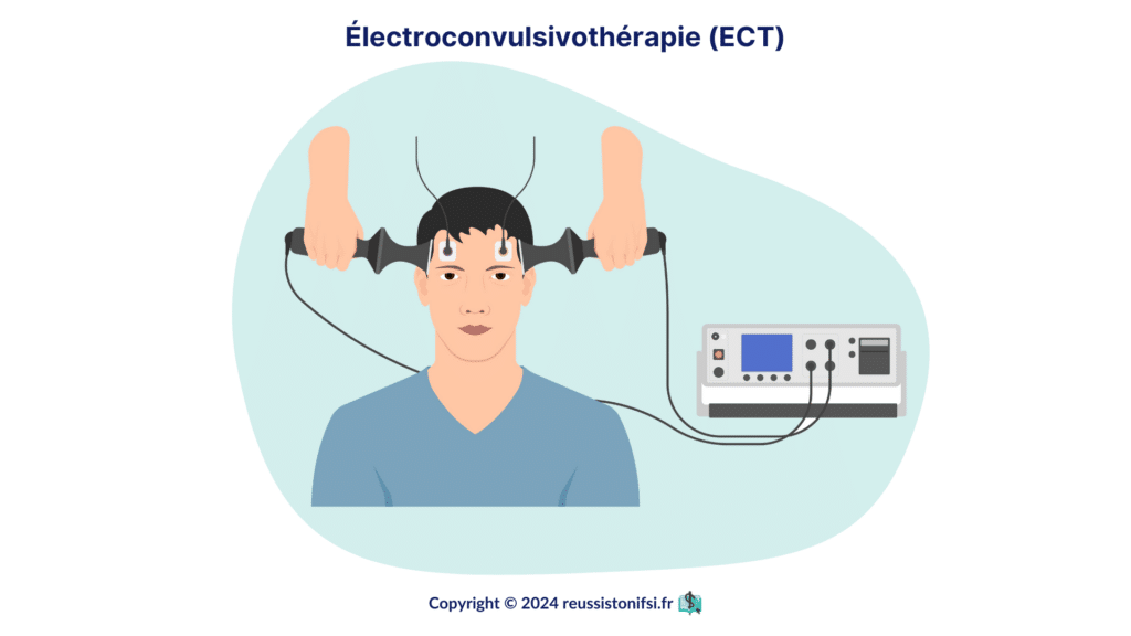 Infographie- Électroconvulsivothérapie (ECT)